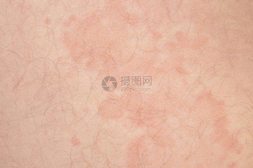 红斑型脚气家庭消毒方法