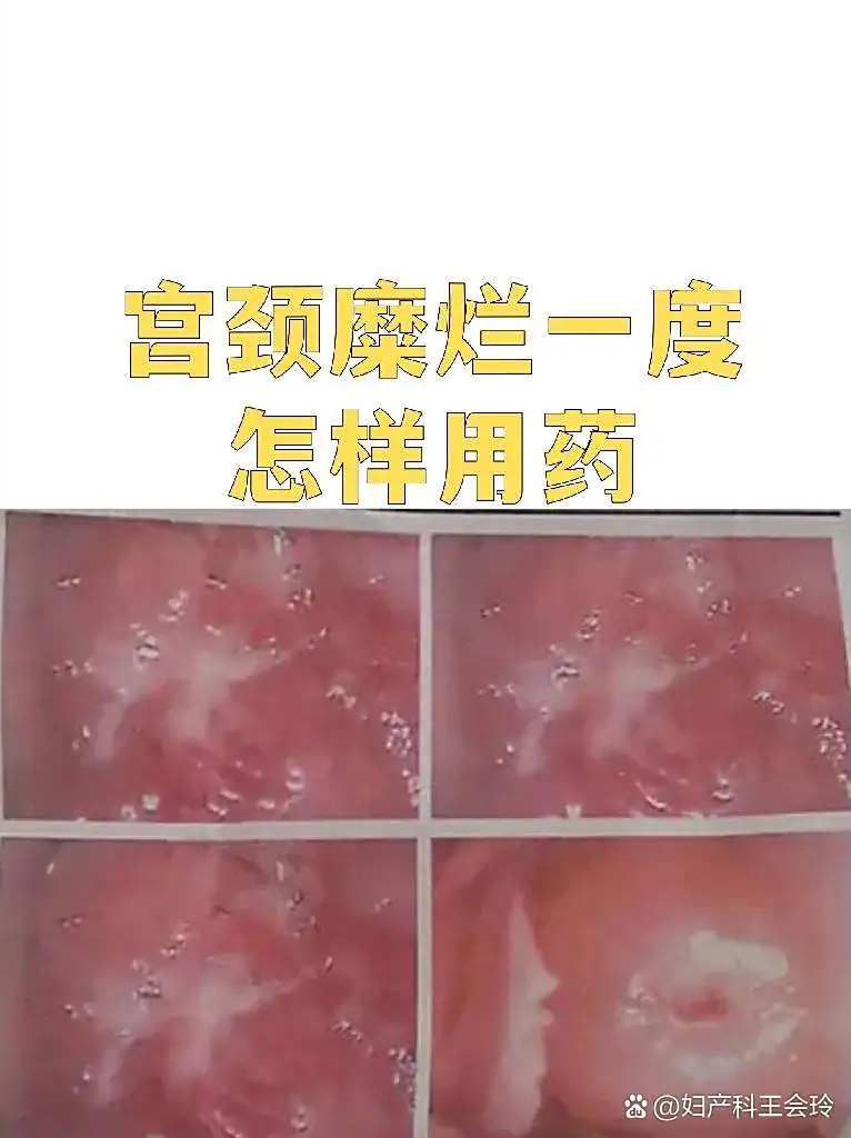 糜烂型脚气出汗后即时清洁实操