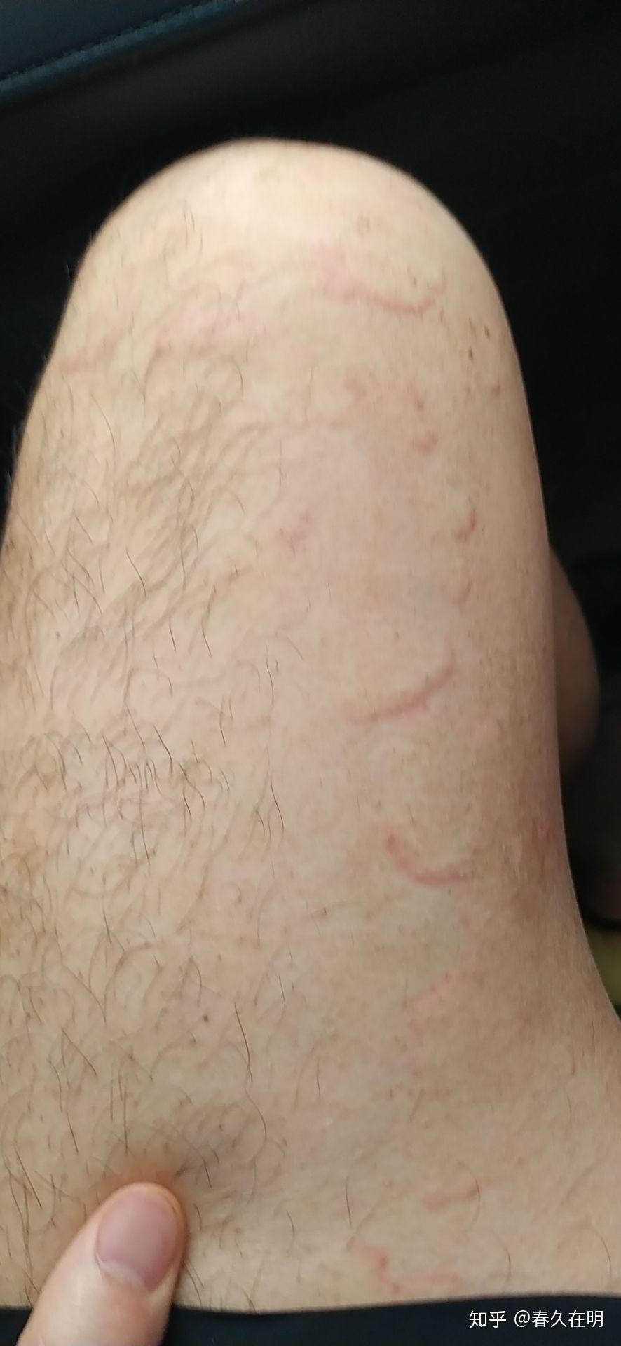环状红斑对症治疗