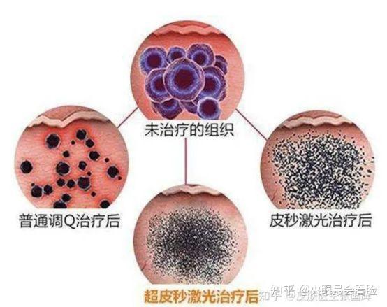 深层红斑调理方案