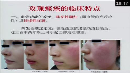 血管性红斑舒缓调理(图1) 血管性红斑舒缓调理