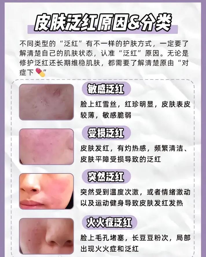 红斑脚气泛红快速消退